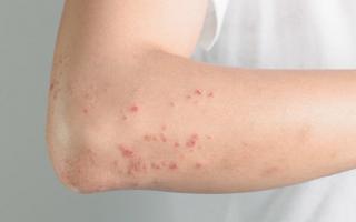 5 biểu hiện chứng tỏ gan đang rất 'nóng', cần thải độc càng sớm càng tốt