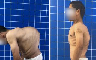 Cắt xương sườn, vén phổi chữa bệnh gù vẹo cho người đàn ông