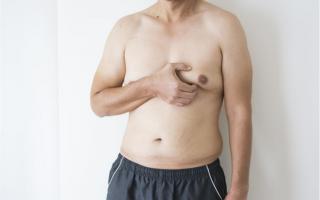 Nỗi khổ của những người đàn ông mang bộ ngực phụ nữ
