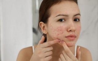 5 dấu hiệu dị ứng mỹ phẩm, làn da đang bị hủy hoại nghiêm trọng